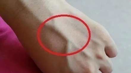 有人手臂上“青筋暴起”，有人卻看不到“青筋”，這是咋回事？
